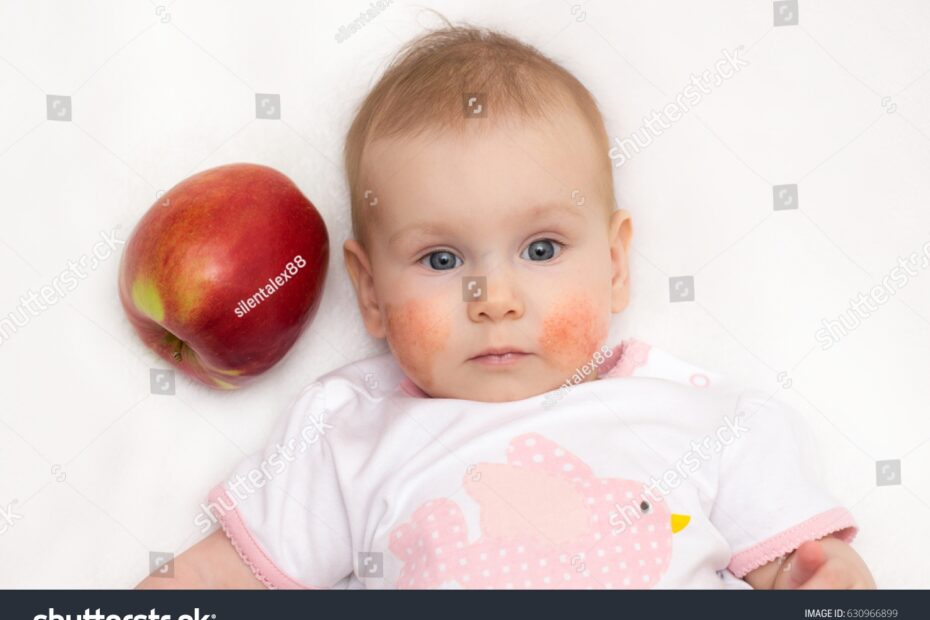 Beautiful Baby Allergic Rash On Cheeks Stock Photo 630966899 Shutterstock
