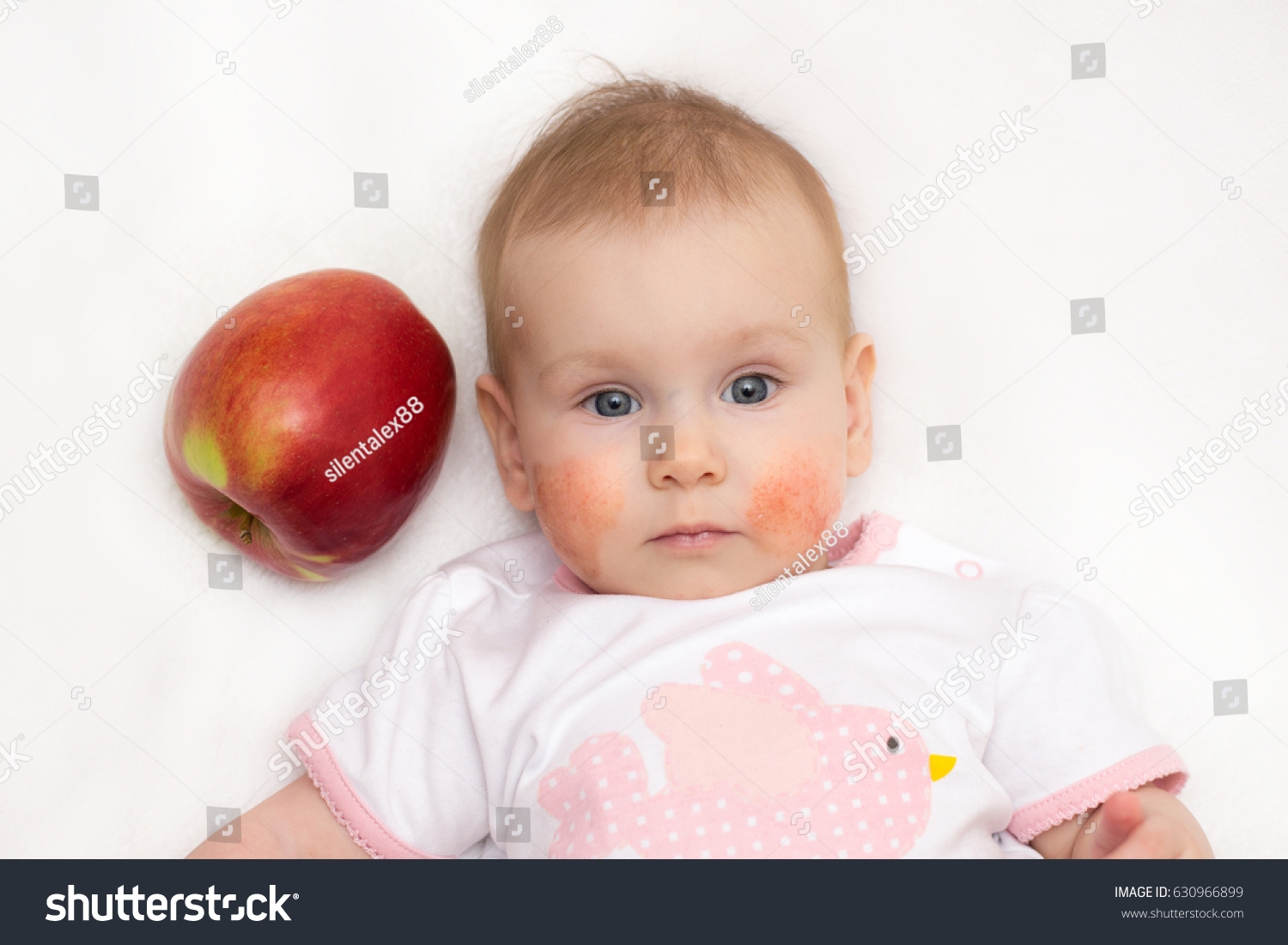 Beautiful Baby Allergic Rash On Cheeks Stock Photo 630966899 Shutterstock