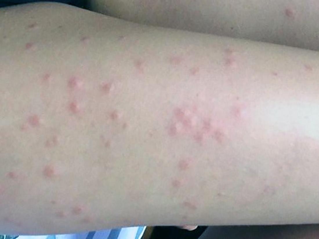 Fly Bites Pictures Types Symptoms And Treatment