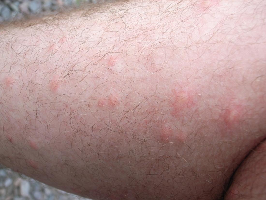 Fly Bites Pictures Types Symptoms And Treatment