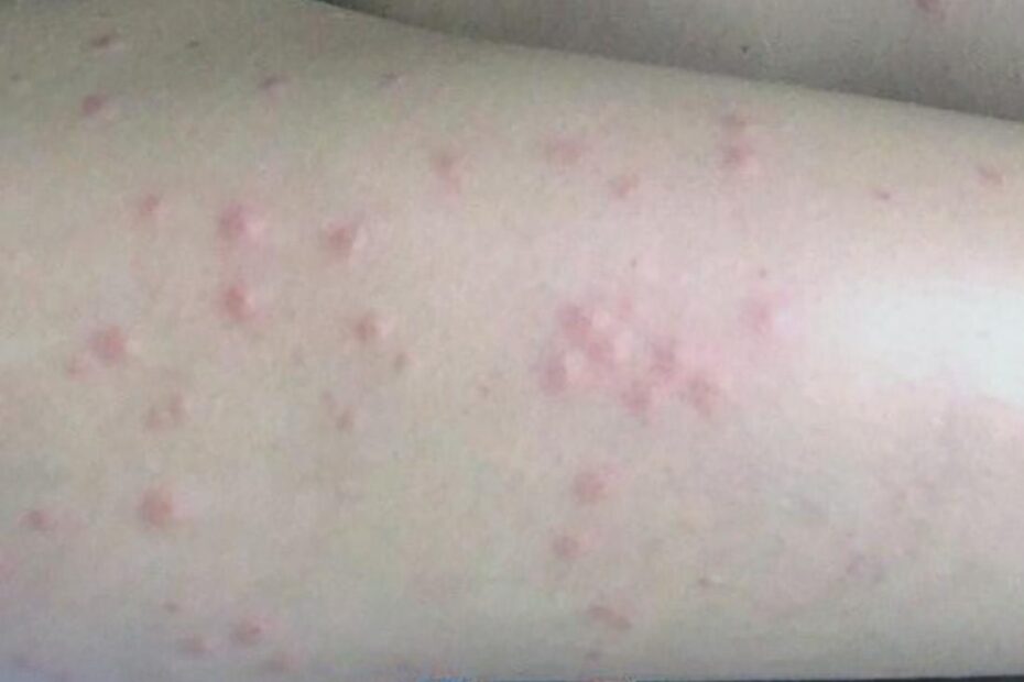 Fly Bites Pictures Types Symptoms And Treatment