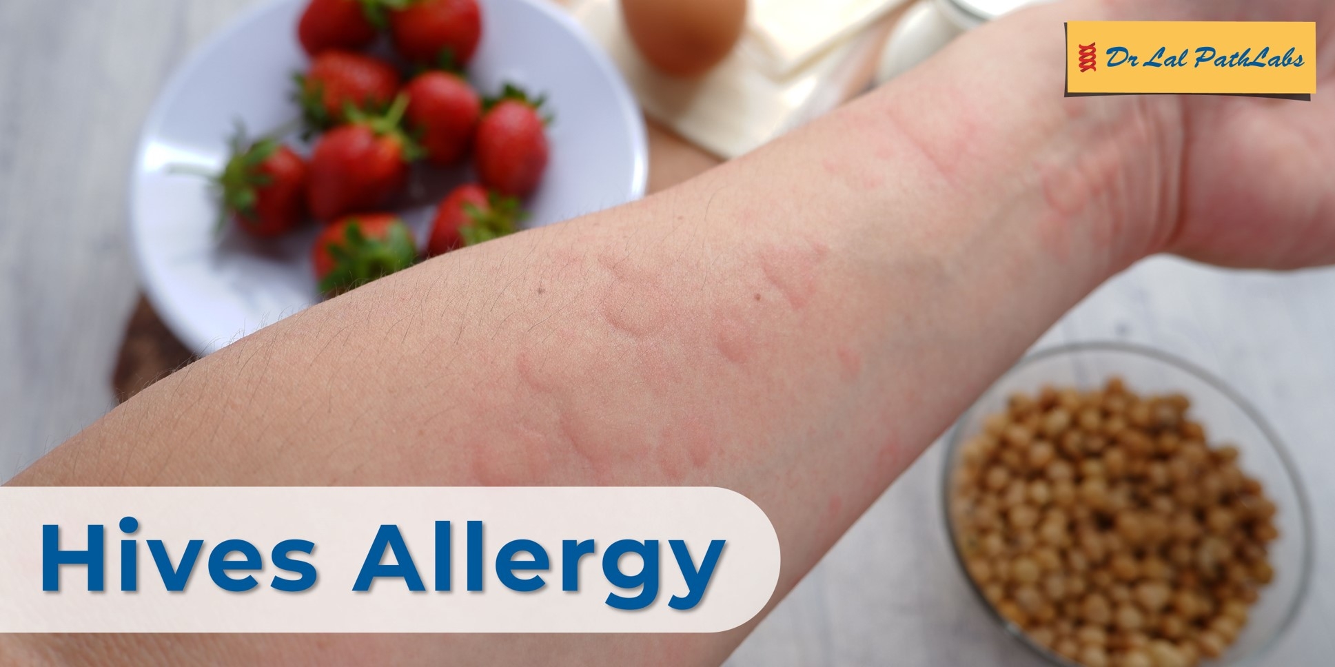 Hives Causes And Diagnosis Dr Lal PathLabs Blogs