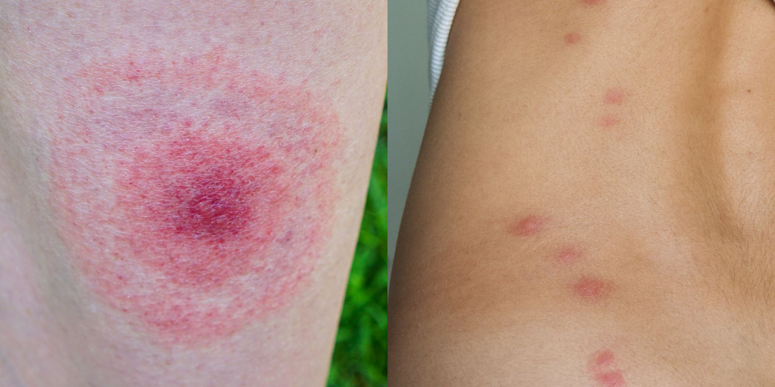 fruit fly rash pictures